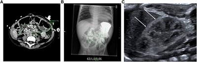 Frequency and impact of enteric hyperoxaluria in pediatric short bowel syndrome: a retrospective single centre study